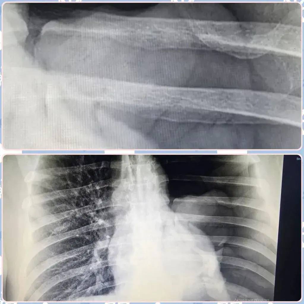 65-летний балаковец при попытке помыть окна получил перелом обеих костей голени 65-летний балаковец при попытке помыть окна получил перелом обеих костей голени