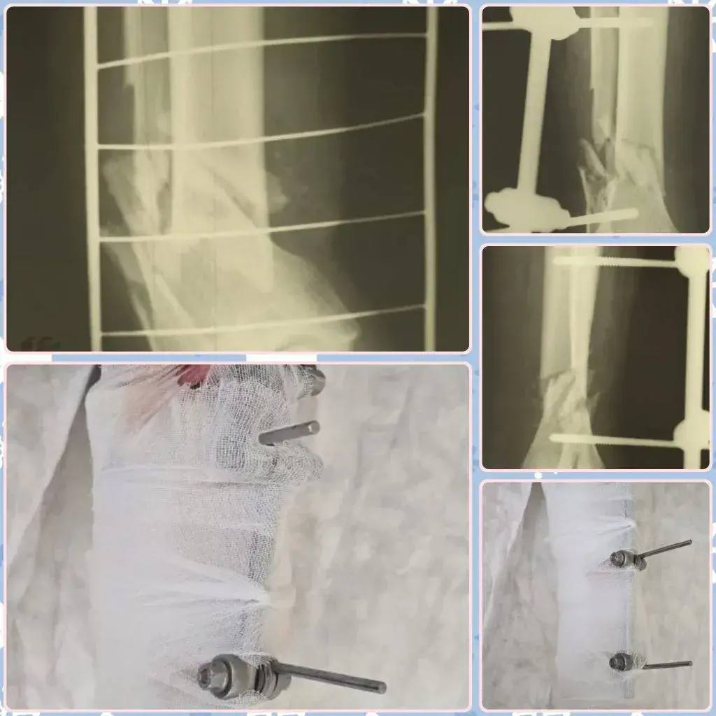 65-летний балаковец при попытке помыть окна получил перелом обеих костей голени