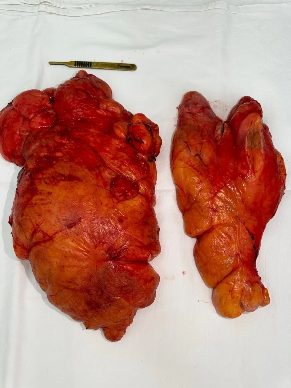 Опухоль весом более 7 килограммов удалили у 85-летней жительницы Балакова Опухоль весом более 7 килограммов удалили у 85-летней жительницы Балакова