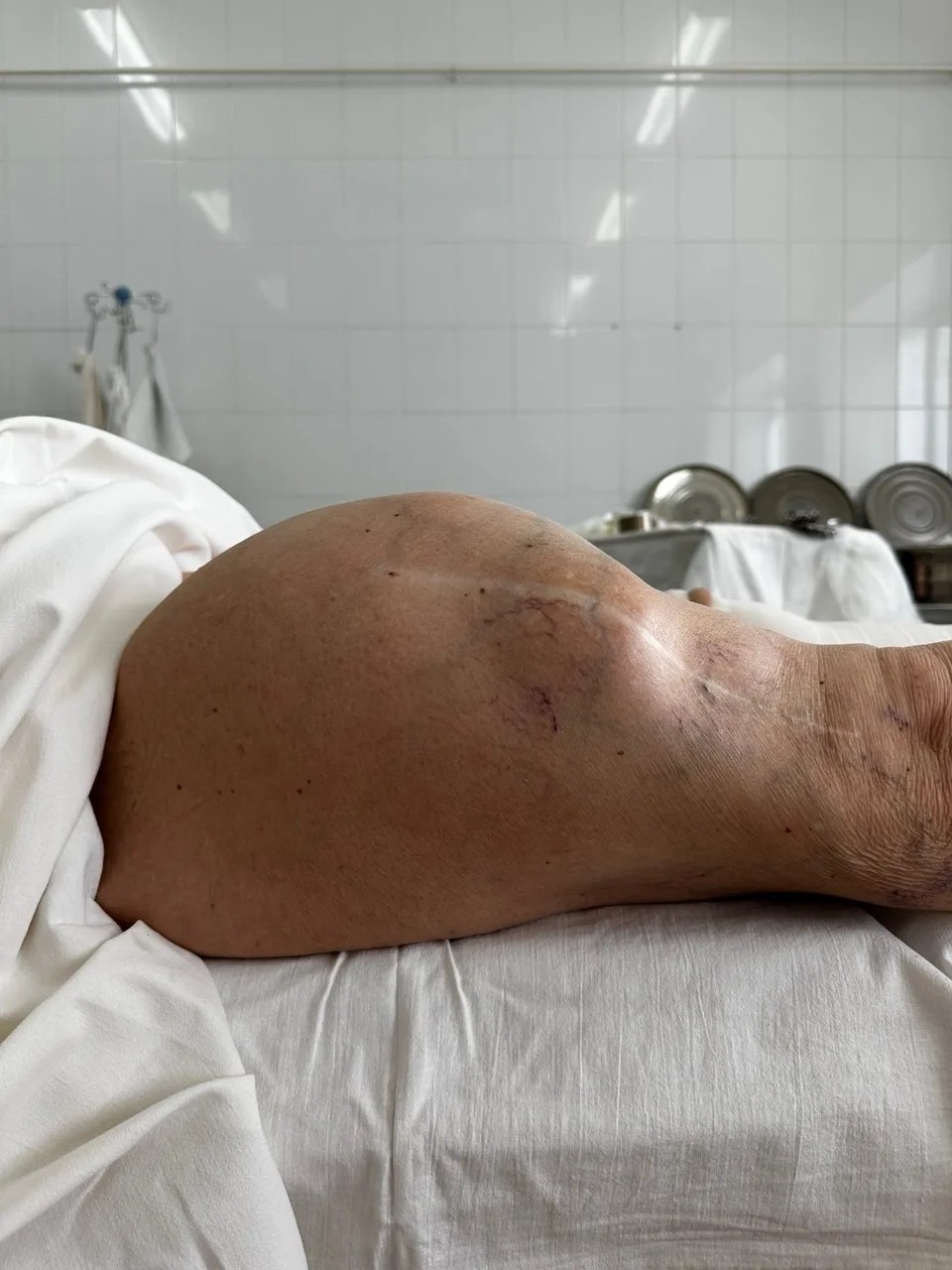 Опухоль весом более 7 килограммов удалили у 85-летней жительницы Балакова Опухоль весом более 7 килограммов удалили у 85-летней жительницы Балакова