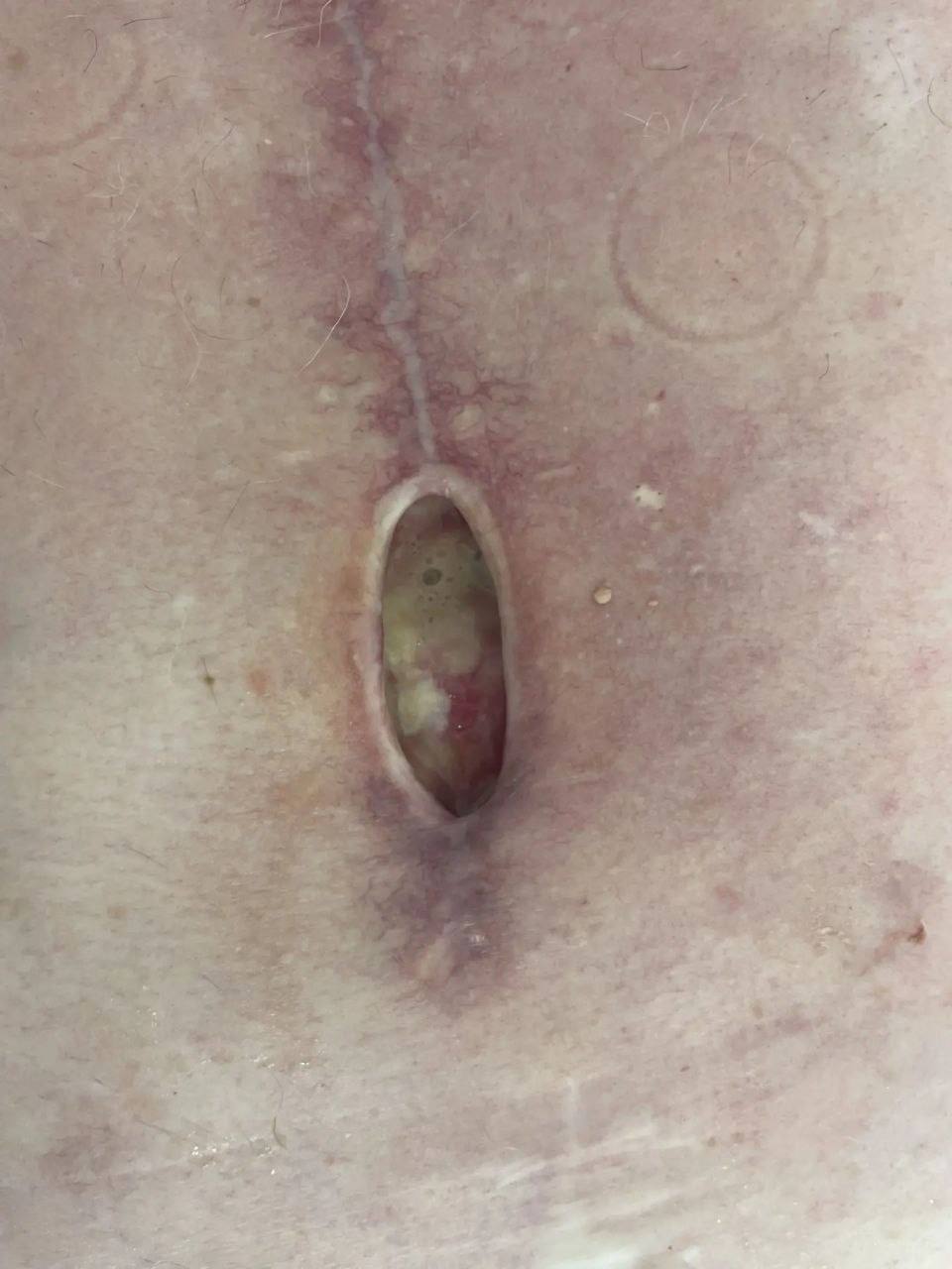 Врачи из Энгельса провели успешное лечение раны пациента с помощью VAC-терапии