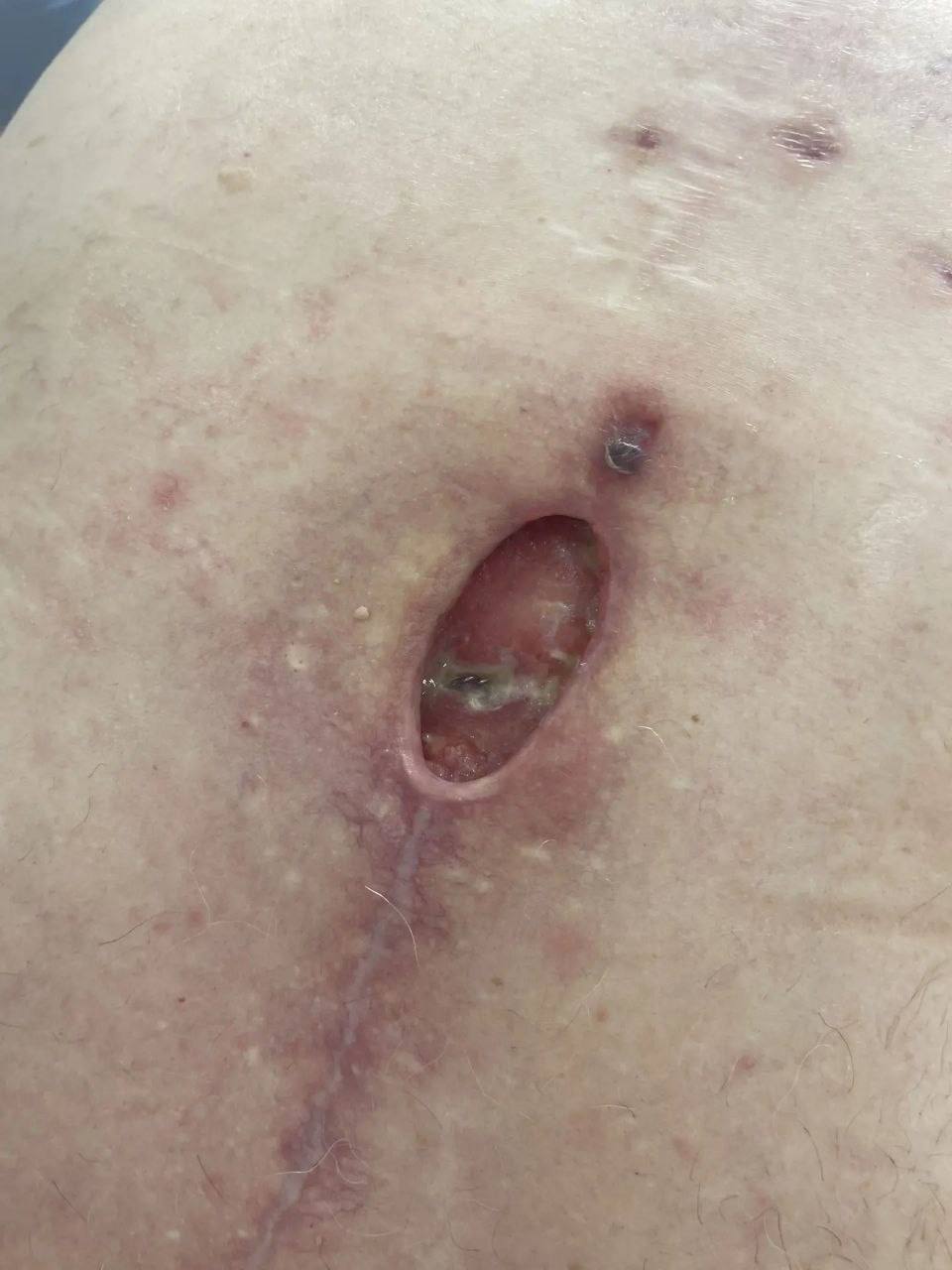 Врачи из Энгельса провели успешное лечение раны пациента с помощью VAC-терапии Врачи из Энгельса провели успешное лечение раны пациента с помощью VAC-терапии