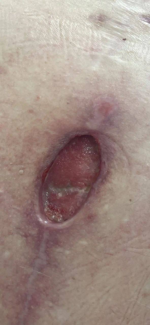 Врачи из Энгельса провели успешное лечение раны пациента с помощью VAC-терапии Врачи из Энгельса провели успешное лечение раны пациента с помощью VAC-терапии