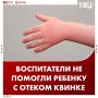 Воспитатели проигнорировали отек Квинке у двухлетнего мальчика