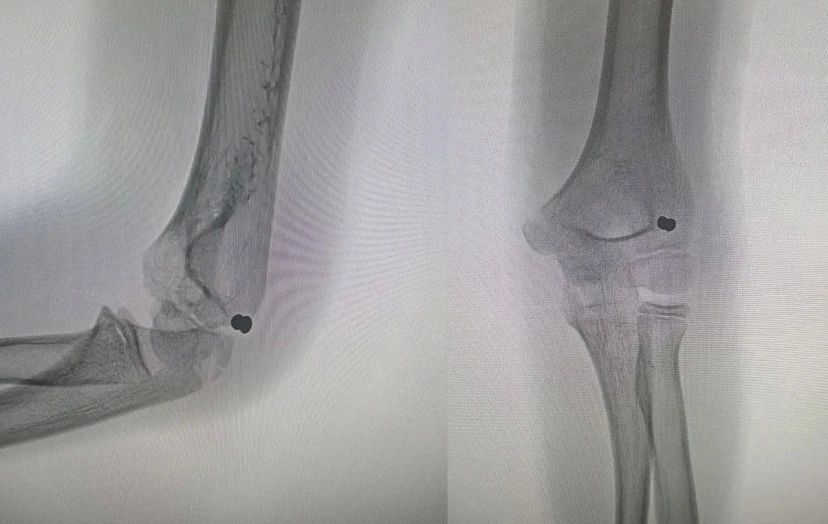 В Саратовской области подростку во время игры прострелили руку из пневмата